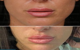 Bullhorn Lip Lift in Islamabad