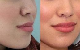 Bullhorn Lip Lift surgery in Islamabad