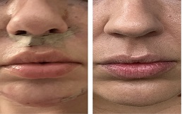 Bullhorn Lip Lift treatment in Islamabad