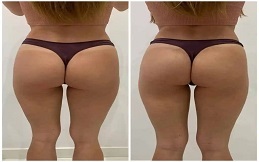 Buttock Augmentation before after results