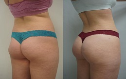 Buttock Lift before after results