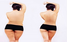 Buttock Lift before after