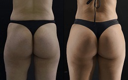 Buttock Lift results