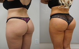 Buttock Lift surgery in Islamabad