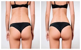Buttock Lift treatment in Islamabad
