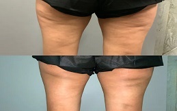 Cellulite removal treatment in Islamabad