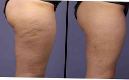Cellulite removal treatment