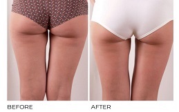 Cellulite treatment before after results