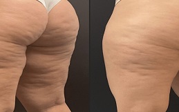 Cellulite treatment before after