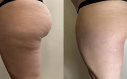 Cellulite treatment in Islamabad