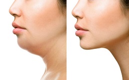 Chin Augmentation in Islamabad