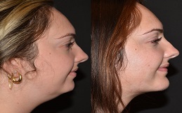 Chin Augmentation surgery in Islamabad