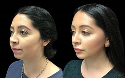 Chin Augmentation treatment in Islamabad