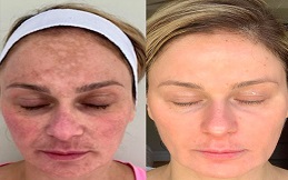 Cosmelan Peeling before after results