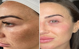 Cosmelan Peeling before after