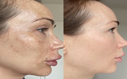 Cosmelan Peeling cost in Islamabad