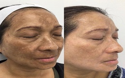 Cosmelan Peeling in Islamabad