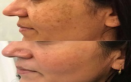 Cosmelan Peeling