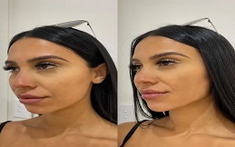 Cosmetic Injectables before after results