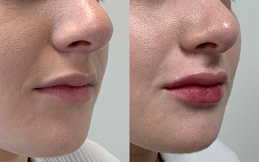 Cosmetic Injectables before after