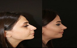 Cost Kybella Treatment in Islamabad
