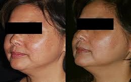 Enlighten Pico Genesis before after