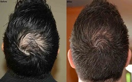 Exosomes Hair Therapy cost in Islamabad