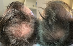 Exosomes Hair Therapy in Islmabad