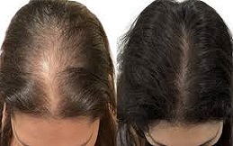 Exosomes Hair Therapy