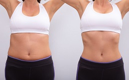 Fat Melting Injection before after