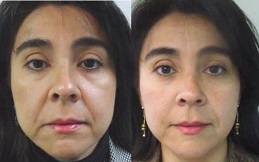 Fotona 4D for Face Lift before after results