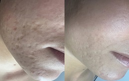 Fractional CO2 Laser Scar before after
