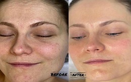 Fractional Laser And PRP Therapy before after results