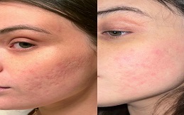 Fractional Laser And PRP Therapy before after