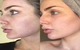 Fractional Laser And PRP Therapy in ISlamabad