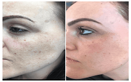 Fractional Laser And PRP Therapy