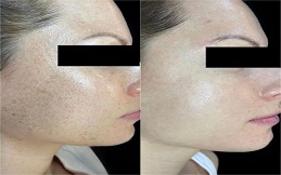 Fractional RF Microneedling before after results