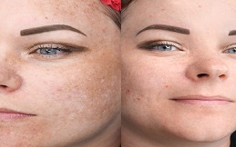 Fractional RF Microneedling before after
