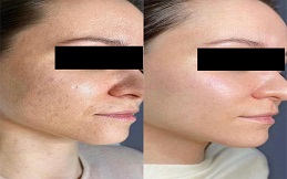 Fractional RF Microneedling cost in Islamabad