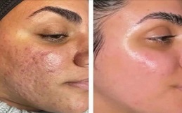 Fractional RF Microneedling in Islamabad