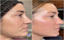 Fractional RF Microneedling