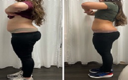 GPS Laser Liposuction before after