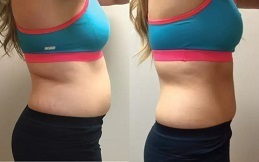 GPS Laser Liposuction in Islamabad