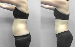 GPS Laser Liposuction treatment in Islamabad