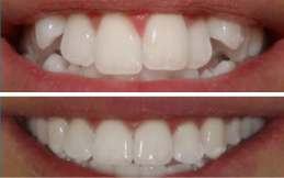 Invisible Braces before after results