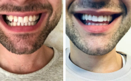 Invisible Braces cost in Islamabad