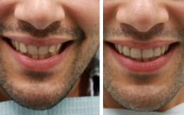 Invisible Braces in Islamabad