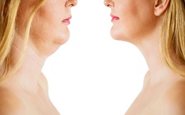 Kybella Surgery in Islamabad