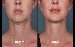 Kybella Treatment before after