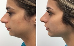 Kybella Treatment in Islamabad